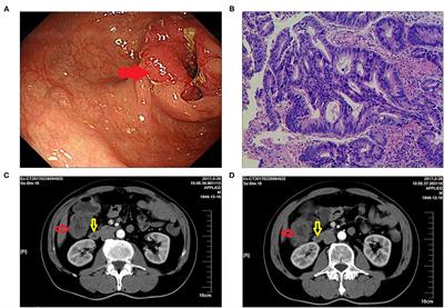 Duodenal-Distal Ileal Fistula After Laparoscopic Radical Right Hemicolectomy: A Case Report